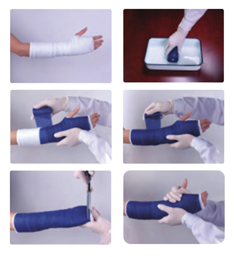 Các bước sử dụng băng đúc chỉnh hình